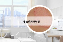 牛皮癣简讯城管