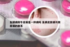 鱼鳞病和牛皮癣是一种病吗 鱼鳞皮肤病与银屑病的联系