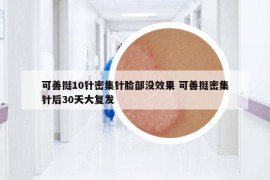 可善挺10针密集针脸部没效果 可善挺密集针后30天大复发