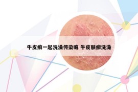 牛皮癣一起洗澡传染嘛 牛皮肤癣洗澡