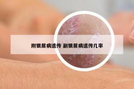 附银屑病遗传 副银屑病遗传几率