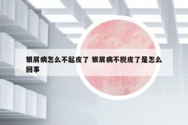 银屑病怎么不起皮了 银屑病不脱皮了是怎么回事