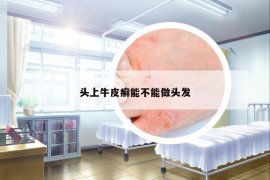 头上牛皮癣能不能做头发