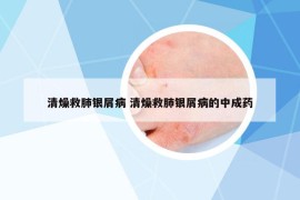清燥救肺银屑病 清燥救肺银屑病的中成药