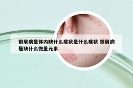 银屑病是体内缺什么症状是什么症状 银屑病是缺什么微量元素