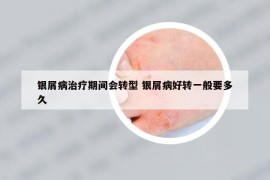 银屑病治疗期间会转型 银屑病好转一般要多久