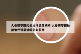 人参茯苓颗粒能治疗银屑病吗 人参茯苓颗粒能治疗银屑病吗怎么服用
