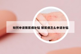 如何申请银屑病补贴 银屑病怎么申请补贴