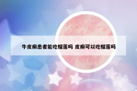 牛皮癣患者能吃榴莲吗 皮癣可以吃榴莲吗