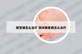 银雪病怎么治疗 斑块银屑病怎么治疗