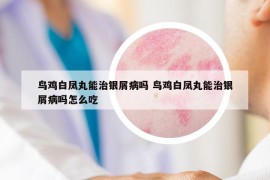 鸟鸡白凤丸能治银屑病吗 鸟鸡白凤丸能治银屑病吗怎么吃