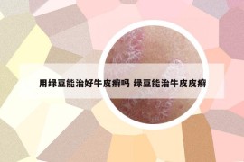 用绿豆能治好牛皮癣吗 绿豆能治牛皮皮癣