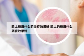 脸上癣用什么药治疗效果好 脸上的癣用什么药膏效果好