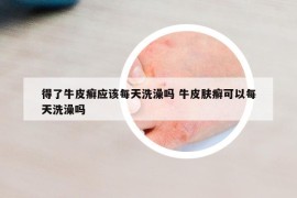 得了牛皮癣应该每天洗澡吗 牛皮肤癣可以每天洗澡吗