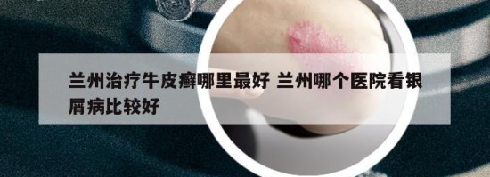 兰州治疗牛皮癣哪里最好 兰州哪个医院看银屑病比较好