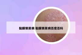 黏膜银屑病 黏膜银屑病百度百科
