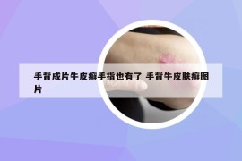手背成片牛皮癣手指也有了 手背牛皮肤癣图片