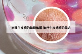 治理牛皮癣的法律依据 治疗牛皮病癣的偏方
