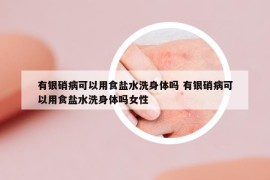 有银硝病可以用食盐水洗身体吗 有银硝病可以用食盐水洗身体吗女性