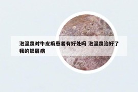 泡温泉对牛皮癣患者有好处吗 泡温泉治好了我的银屑病
