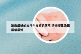 济南最好的治疗牛皮癣的医院 济南哪里治银屑病最好