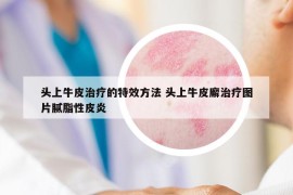 头上牛皮治疗的特效方法 头上牛皮廨治疗图片腻脂性皮炎