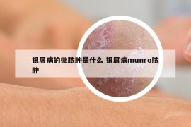银屑病的微脓肿是什么 银屑病munro脓肿