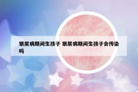 银屑病期间生孩子 银屑病期间生孩子会传染吗