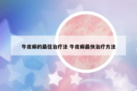 牛皮癣的最佳治疗法 牛皮癣最快治疗方法