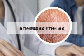 肛门会得银屑病吗 肛门会生癣吗