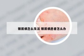 银屑病怎么生活 银屑病患者怎么办