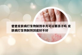 爸爸皮肤病打生物制剂半月可以要孩子吗 皮肤病打生物制剂到底好不好