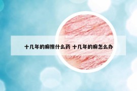十几年的癣擦什么药 十几年的癣怎么办