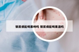 银屑病能喝果啤吗 银屑病能喝果酒吗