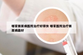 哪家银屑病医院治疗好得快 哪家医院治疗银屑病最好