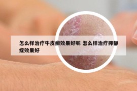 怎么样治疗牛皮癣效果好呢 怎么样治疗抑郁症效果好