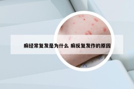 癣经常复发是为什么 癣反复发作的原因