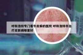 呼和浩特专门看牛皮癣的医院 呼和浩特市治疗皮肤病哪里好
