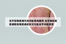 关节型银屑病与肾功能衰竭案例 关节病性银屑病既有银屑病皮损又引起关节功能损害