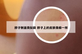 脖子侧面类似藓 脖子上的皮肤像癣一样