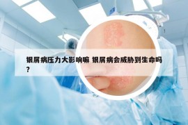 银屑病压力大影响嘛 银屑病会威胁到生命吗?