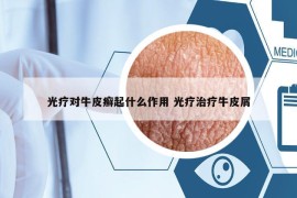 光疗对牛皮癣起什么作用 光疗治疗牛皮屑