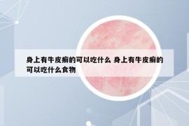 身上有牛皮癣的可以吃什么 身上有牛皮癣的可以吃什么食物