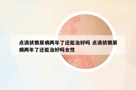点滴状银屑病两年了还能治好吗 点滴状银屑病两年了还能治好吗女性