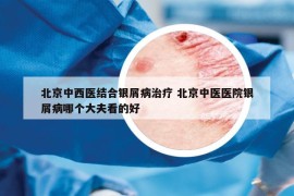北京中西医结合银屑病治疗 北京中医医院银屑病哪个大夫看的好