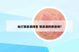 拍打银屑病博客 银屑病按摩视频?