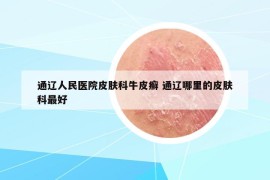 通辽人民医院皮肤科牛皮癣 通辽哪里的皮肤科最好