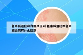 色素减退痣和白癜风区别 色素减退痣跟色素减退斑有什么区别