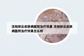 沈阳祥云皮肤病医院治疗效果 沈阳祥云皮肤病医院治疗效果怎么样