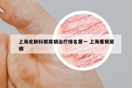 上海皮肤科银屑病治疗排名第一 上海看银屑病